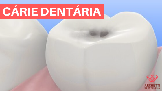 Cárie Dentária: Tudo sobre esse problema